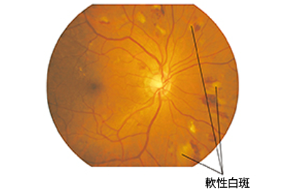 糖尿病網膜症　第二段階　画像