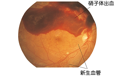 糖尿病網膜症　第三段階　画像